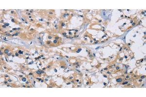 Immunohistochemistry of paraffin-embedded Human thyroid cancer using IL17RB Polyclonal Antibody at dilution of 1:40 (IL17 Receptor B antibody)