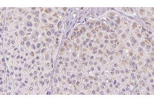 ABIN6277763 at 1/100 staining Human melanoma tissue by IHC-P. (CCL2 antibody  (Internal Region))