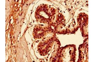 Immunohistochemistry of paraffin-embedded human breast cancer using ABIN7157408 at dilution of 1:100 (KRT81 antibody  (AA 3-505))