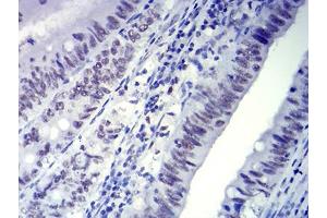 Immunohistochemical analysis of paraffin-embedded rectum cancer tissues using CTNNBL1 mouse mAb with DAB staining. (CTNNBL1 antibody  (AA 390-557))
