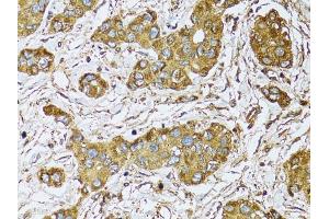 Immunohistochemistry of paraffin-embedded human liver cancer using μgDH antibody (ABIN5970552) at dilution of 1/100 (40x lens).