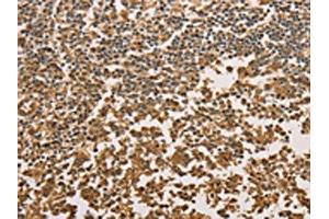 The image on the left is immunohistochemistry of paraffin-embedded Human tonsil tissue using ABIN7131042(SETD2 Antibody) at dilution 1/40, on the right is treated with fusion protein. (SETD2 antibody)
