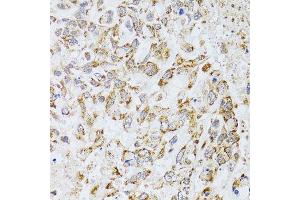 Immunohistochemistry of paraffin-embedded human lung cancer using AIFM3 antibody (ABIN5996156) at dilution of 1/100 (40x lens). (AIFM3 antibody)