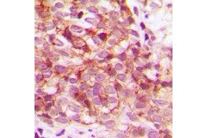 Immunohistochemical analysis of CDK15 staining in human breast cancer formalin fixed paraffin embedded tissue section. (Cyclin-Dependent Kinase 15 (ALS2CR7) antibody)