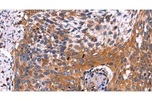 Immunohistochemistry of paraffin-embedded Human cervical cancer using RDX Polyclonal Antibody at dilution of 1:60 (Radixin antibody)