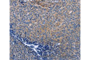 Immunohistochemistry of Human cervical cancer using INTS10 Polyclonal Antibody at dilution of 1:50 (INTS10 antibody)