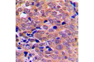 Immunohistochemical analysis of AMPK alpha 1/2 staining in human breast cancer formalin fixed paraffin embedded tissue section. (PRKAA1/PRKAA2 antibody  (Center))