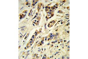 Formalin-fixed and paraffin-embedded human breast carcinoma reacted with IL10 Antibody (Center), which was peroxidase-conjugated to the secondary antibody, followed by DAB staining.
