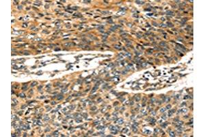 The image on the left is immunohistochemistry of paraffin-embedded Human esophagus cancer tissue using ABIN7128026(STX19 Antibody) at dilution 1/35, on the right is treated with fusion protein. (Syntaxin 19 antibody)
