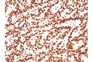 Formalin-fixed, paraffin-embedded human Breast Carcinoma stained with Estrogen Receptor alpha Mouse Monoclonal Antibody (ESR1/3559). (Estrogen Receptor alpha antibody  (AA 129-312))