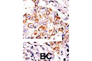 Formalin-fixed and paraffin-embedded human cancer tissue reacted with NME3 polyclonal antibody  , which was peroxidase-conjugated to the secondary antibody, followed by DAB staining. (NME3 antibody  (Internal Region))