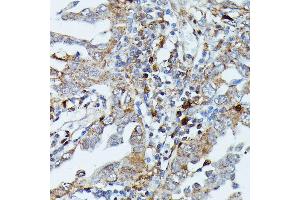 Immunohistochemistry of paraffin-embedded human lung cancer using MEKK3 antibody (ABIN7268652) at dilution of 1:100 (40x lens). (MAP3K3 antibody  (AA 1-220))