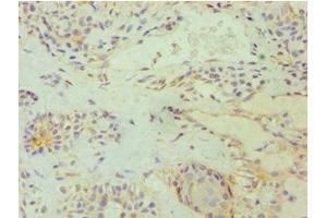 Immunohistochemistry of paraffin-embedded human breast cancer using ABIN7172529 at dilution of 1:100 (E2F6 antibody  (AA 1-281))
