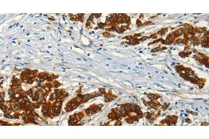 Immunohistochemistry of paraffin-embedded Human colon cancer using ADCY3 Polyclonal Antibody at dilution of 1:50 (ADCY3 antibody)