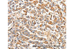 Immunohistochemistry of Human breast cancer using BAK1 Polyclonal Antibody at dilution of 1:50