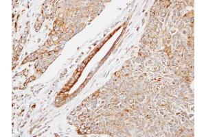 IHC-P Image Immunohistochemical analysis of paraffin-embedded human lung SCC, using HSP22, antibody at 1:500 dilution. (HSPB8 antibody  (C-Term))