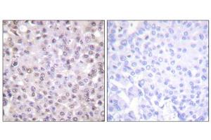 Immunohistochemistry analysis of paraffin-embedded human breast carcinoma, tissue using NCoR1 antibody.