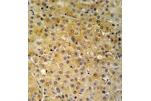 Immunohistochemistry analysis in formalin fixed and paraffin embedded hepatocarcinoma reacted with NDUFA10 Antibody (Center) followed which was followed by peroxidase conjugated to the secondary antibody and DAB staining. (NDUFA10 antibody  (Middle Region))