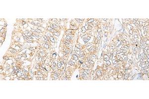 Immunohistochemistry of paraffin-embedded Human gastric cancer tissue using NME4 Polyclonal Antibody at dilution of 1:45(x200)
