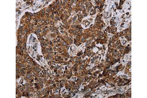Immunohistochemistry of Human liver cancer using NDUFA4 Polyclonal Antibody at dilution of 1:40