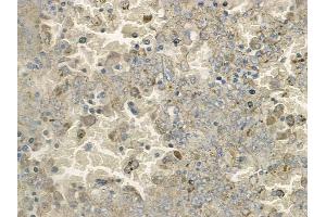 ABIN6265511 and ABIN6272444 at 1/100 staining human melanoma by IHC-P.