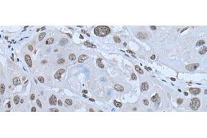 Immunohistochemistry of paraffin-embedded Human esophagus cancer tissue using HAND1 Polyclonal Antibody at dilution of 1:30(x200) (HAND1 antibody)