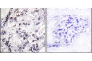 Immunohistochemistry analysis of paraffin-embedded human breast carcinoma tissue, using hnRNP C1/2 (Ab-260) Antibody. (HNRNPC antibody  (AA 231-280))