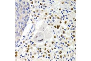 Immunohistochemistry of paraffin-embedded human lung cancer using GEMIN2 Antibody. (SIP1 antibody)