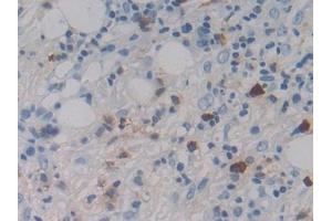 Detection of MASP1 in Human Skin cancer Tissue using Polyclonal Antibody to Mannose Associated Serine Protease 1 (MASP1) (MASP1 antibody  (AA 20-447))