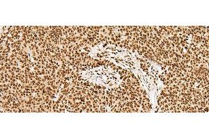 Immunohistochemistry of paraffin-embedded Human ovarian cancer tissue using GRSF1 Polyclonal Antibody at dilution of 1:30(x200) (GRSF1 antibody)