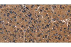 Immunohistochemistry of paraffin-embedded Human liver cancer using CD242 Polyclonal Antibody at dilution of 1:50 (ICAM4 antibody)