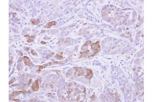 IHC-P Image Immunohistochemical analysis of paraffin-embedded A549 xenograft, using Villin , antibody at 1:500 dilution. (Villin 1 antibody  (N-Term))