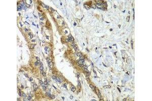 Immunohistochemistry of paraffin-embedded Human liver cancer using CDC16 Polyclonal Antibody at dilution of 1:100 (40x lens). (CDC16 antibody)