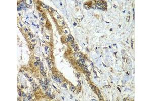 Immunohistochemistry of paraffin-embedded Human liver cancer using CDC16 Polyclonal Antibody at dilution of 1:100 (40x lens).