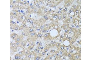 Immunohistochemistry of paraffin-embedded Human liver damage using AARS2 Polyclonal Antibody at dilution of 1:100 (40x lens). (AARS2 antibody)