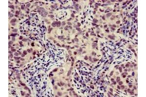 Immunohistochemistry of paraffin-embedded human pancreatic cancer using ABIN7175883 at dilution of 1:100 (XBP1 antibody  (AA 1-167))