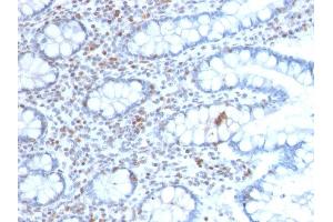 Formalin-fixed, paraffin-embedded human Colon Carcinoma stained with BMI1-Monospecific Mouse Monoclonal Antibody (BMI1/2689). (BMI1 antibody  (AA 142-326))