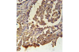 MC2R Antibody (C-term) (ABIN651731 and ABIN2840379) immunohistochemistry analysis in formalin fixed and paraffin embedded human skin carcinoma followed by peroxidase conjugation of the secondary antibody and DAB staining. (MC2R antibody  (AA 261-288))