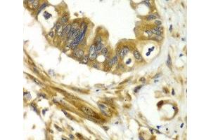 Immunohistochemistry of paraffin-embedded Human liver cancer using GBP1 Polyclonal Antibody at dilution of 1:100 (40x lens). (GBP1 antibody)