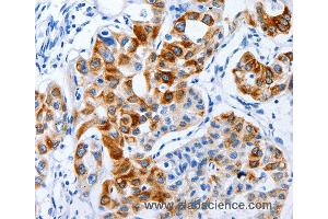 Immunohistochemistry of Human lung cancer using BPIFB3 Polyclonal Antibody at dilution of 1:120 (BPIFB3 antibody)