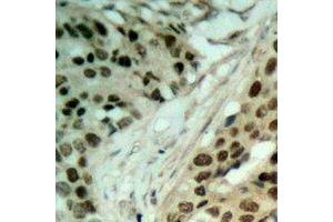 Immunohistochemical analysis of NAT5 staining in human ovarian cancer formalin fixed paraffin embedded tissue section. (NAT5 antibody)