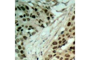 Immunohistochemical analysis of NAT5 staining in human ovarian cancer formalin fixed paraffin embedded tissue section.