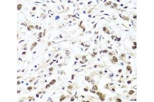 Immunohistochemistry of paraffin-embedded Human gastric cancer using HIRA Polyclonal Antibody at dilution of 1:100 (40x lens). (HIRA antibody)