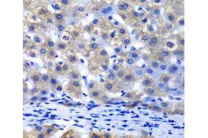 Immunohistochemistry of paraffin-embedded Human liver damage using PSMD8 Polyclonal Antibody at dilution of 1:100 (40x lens). (PSMD8 antibody)