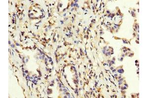 IHC image of ABIN7159260 diluted at 1:200 and staining in paraffin-embedded human lung cancer performed on a Leica BondTM system. (MAGEA3 antibody  (AA 2-104))