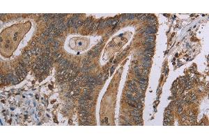 Immunohistochemistry of paraffin-embedded Human colon cancer tissue using MRGPRX1 Polyclonal Antibody at dilution 1:40 (MRGPRX1 antibody)