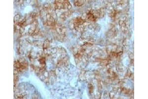 Formalin-fixed, paraffin-embedded human renal cell carcinoma stained with Cadherin 16 antibody (CDH16/1071)