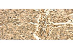 Immunohistochemistry of paraffin-embedded Human lung cancer using SEPT2 Polyclonal Antibody at dilution of 1/30 (Septin 2 antibody)