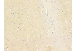 ABIN6264831 and ABIN6279042 at 1/100 staining human glioblastoma by IHC-P.