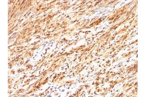 Formalin-fixed, paraffin-embedded human Schwanoma stained with S100B Rabbit Polyclonal Antibody. (S100B antibody)